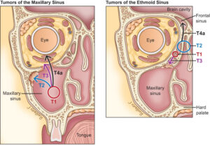 F31: Sinus cancer staging (schematic)