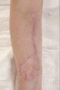 F33: Six months post repair of radial forearm free flap donor side with abdominal full thickness skin graft