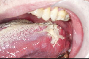 F34: Tongue cancer requiring extensive resection and free flap reconstruction