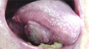 F35: Tongue cancer requiring extensive resection and free flap reconstruction