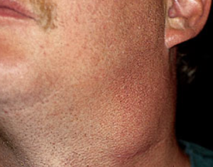 F35: Neck lump – in this case, the lump was a level II metastatic lymph node of unknown primary