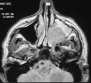 F37: MRI image of sinus cancer