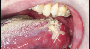 F39: Cancer of the tongue