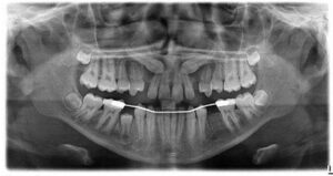 F4: OPG image of impacted maxillary canines