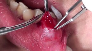 F4: Excision of lower lip mucocele under local anaesthetic