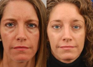 F4: Pre (LEFT) and post (RIGHT) upper and lower blepharoplasties