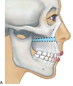 F4: LeFort I maxillary osteotomy – maxilla impacted in new position