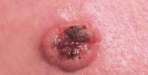 F4: Close-up appearance of cutaneous BCC