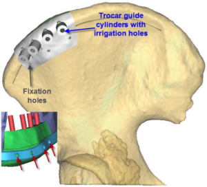 F4: LEFT mandible ameloblastoma. Resection and reconstruction using 3D printer, Proplan and patient specific PSP guides: The guide for the DCIA free flap harvest