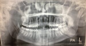 F4: OPG image of LEFT body mandible fracture