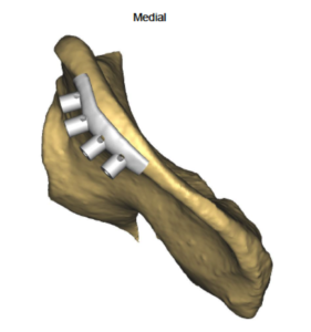 F5: LEFT mandible ameloblastoma. Resection and reconstruction using 3D printer, Proplan and patient specific PSP guides: The guide for the DCIA free flap harvest