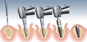 F5: Schematic representation of insertion of osseointegrated dental implant