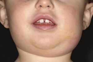 F5: Bilateral parotid swelling in mumps