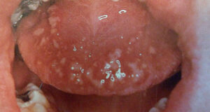 F5: Herpitoform apthous ulcers