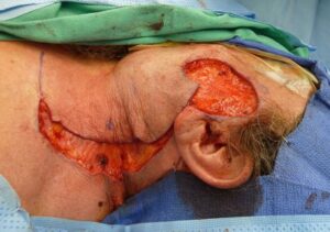 F5: Cervicofacial rotation/transposition flap following excision of cheek cutaneous SCC – note the substantial defect that this simple flap can cover