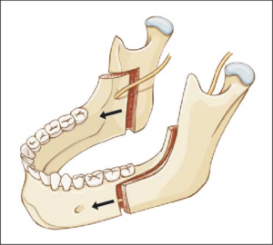 F5: Schematic representation of bilateral sagittal split mandibular ramus osteotomy (BSSO)