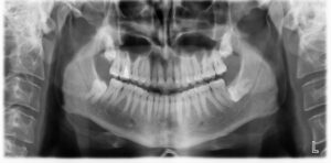 F5: OPG image of impacted wisdom teeth