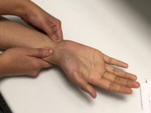 F5: Allen’s test: Open the hand and keep it in a relaxed position, at the height of the level of the heart. DO NOT hyperextend the fingers, as this might result in a false positive test