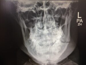 F5: PA mandible image of LEFT angle mandible fracture