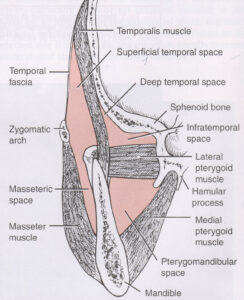 F5: Anatomical boundaries of facial spaces around the ramous of the mandible. Patients with infections in those spaces present with significant trismus