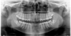 F6: OPG image of impacted wisdom teeth