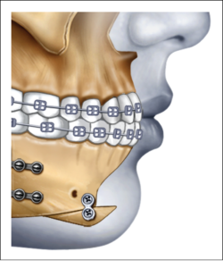 F6: Genioplasty – chin advancement