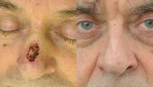 F6: Nasal defect following BCC excision repaired with a full thickness skin graft