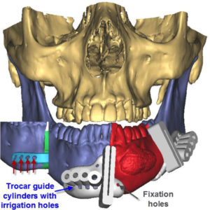 F6: LEFT mandible ameloblastoma. Resection and reconstruction using 3D printer, Proplan and patient specific PSP guides: The guide for the tumour resection