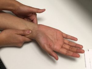 F6: Allen’s test: Release the ulnar artery. A blush of the hand (including index finger and thumb) within 10-12 seconds indicates a negative test and the RFFF can be used