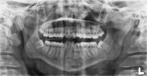 F6: OPG image of LEFT angle mandible fracture