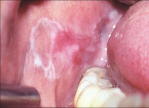 F6: Erosive lichen planus on the buccal mucosa