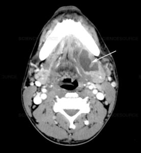 F6: CT image of submandibular abscess