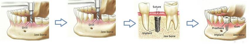 F6: Schematic representation of insertion of osseointegrated dental implant