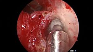 F6: Endoscopic sinus surgery