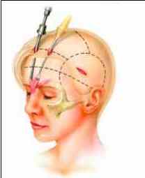 F7: Schematic representation of endoscopic browlift