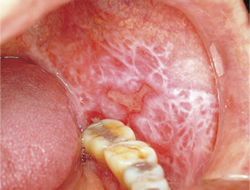 F7: Erosive and reticular lichen planus on the buccal mucosa