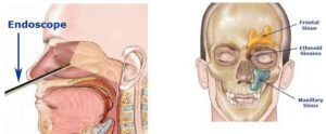 F7: Endoscopic sinus and skull base surgery (schematic)