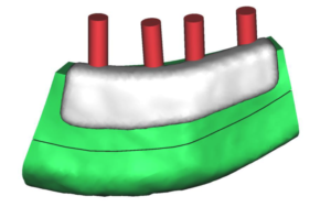 F7: LEFT mandible ameloblastoma. Resection and reconstruction using 3D printer, Proplan and patient specific PSP guides: The guide for the osseointegrated dental implants