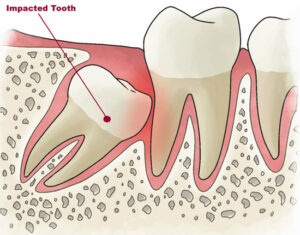 F7: Schematic representation of insertion of mesioangular impacted wisdom tooth