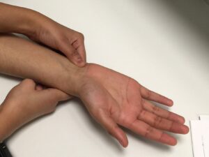 F7: Repeat the test for the radial artery (reverse Allen’s test)