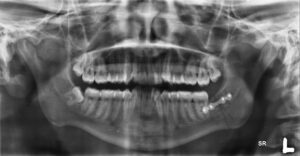 F7: Post-op OPG image of LEFT angle mandible fracture following open reduction and internal fixation with a titanium mini plate