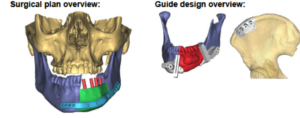 F8: LEFT mandible ameloblastoma. Resection and reconstruction using 3D printer, Proplan and patient specific PSP guides: Overview