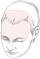 F8: Schematic representation of endoscopic browlift - pull vectors