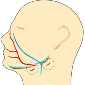 F8: Lines of safety for extraoral incision and drainage of submandibular abscess