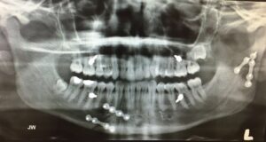 F8: Post-op OPG image of RIGHT parasymphysis and LEFT condyle mandible fractures following open reduction and internal fixation with titanium mini plates