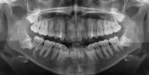 F8: OPG image of impacted wisdom teeth