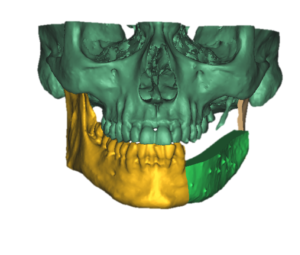 F9: LEFT mandible SCC: Resection and reconstruction using 3D printer, Proplan and patient specific PSP guides: Overview