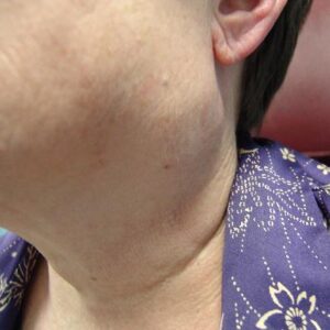 F9: Parotid lump: Pleomorphic adenoma