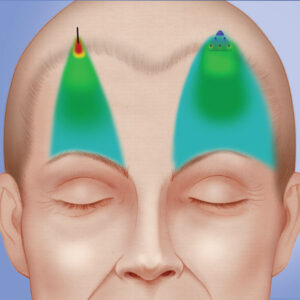 Endoscopic browlift with the use of Endotine