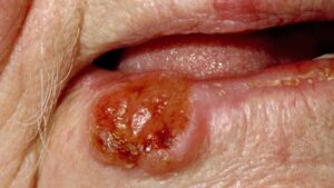 F9: Early cancer of the lower lip